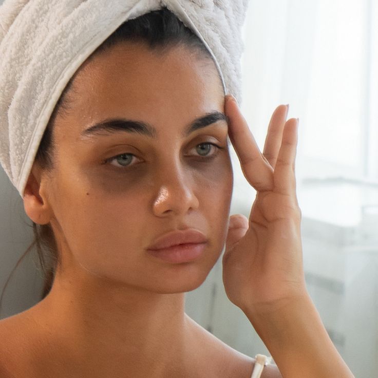 Woman worried about her dark circles