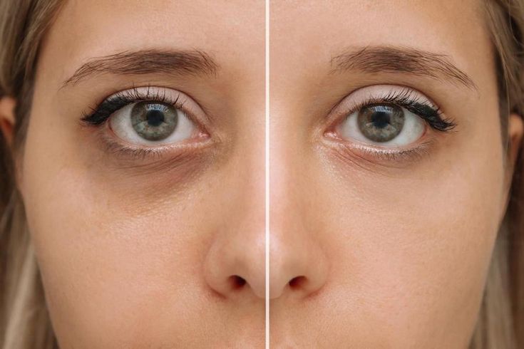 dark circles before and after